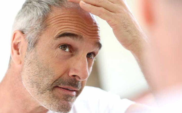Tips to Cover and Treat Thinning Hair in Men