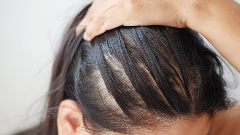Mane Matters: A Comprehensive Guide on How to Prevent Hair Loss in Men and Women