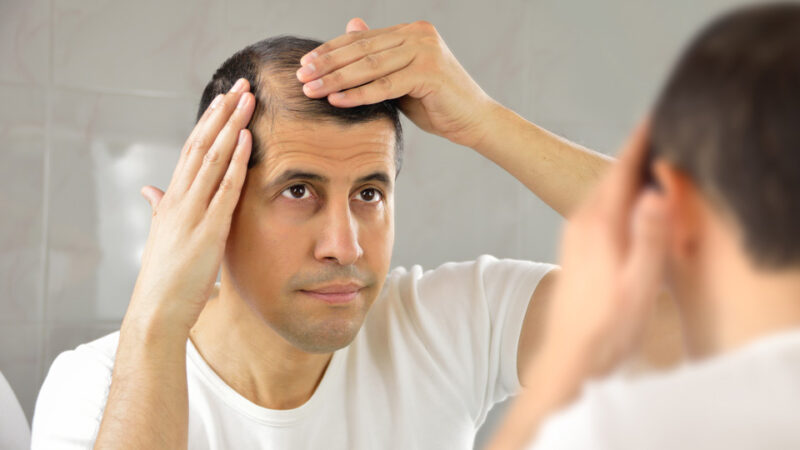 Unraveling the Threads: A Comprehensive Exploration of Male Pattern Baldness – Causes, Symptoms, and Treatment Strategies