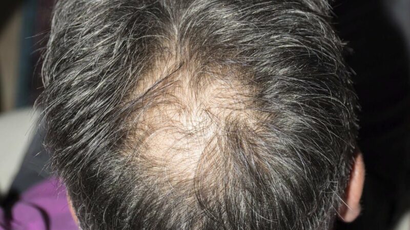 The Tangled Web: Unraveling the Connection Between Stress and Hair Loss