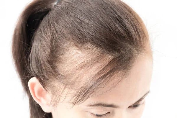 Strands of Strength: Navigating Thinning Hair in Women and Hair Loss – Comprehensive Advice and Insight into the Reasons