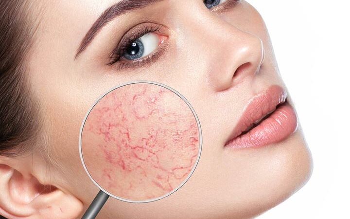 6 Quick Ways To Get Rid Of Broken Capillaries On The Face