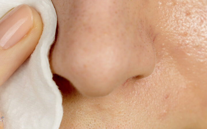 Unveiling Radiance: A Comprehensive Guide on How to Use Hydrogen Peroxide to Remove Blackheads