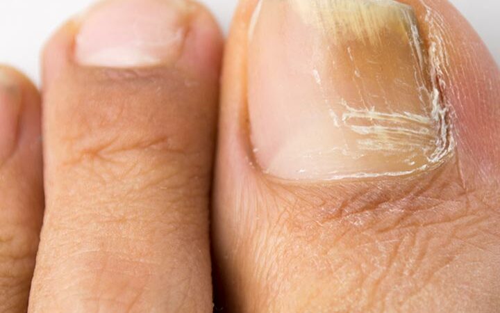 Mastering Nail Fungus Treatment: A Comprehensive Step-by-Step Guide to Using Hydrogen Peroxide